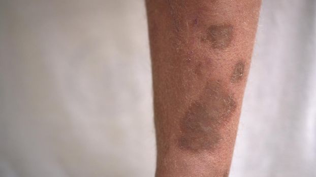 Pigmented spots and ulcers on a person's leg after varicose vein surgery Disease of the human skin. Leg on a white background. 4k