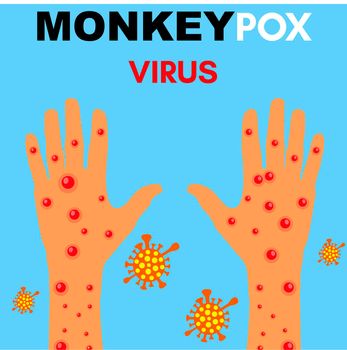 Monkeypox virus Illustration, vector of Hands with monkeypox, monkeypox virus outbreak pandemic design with microscopic view background