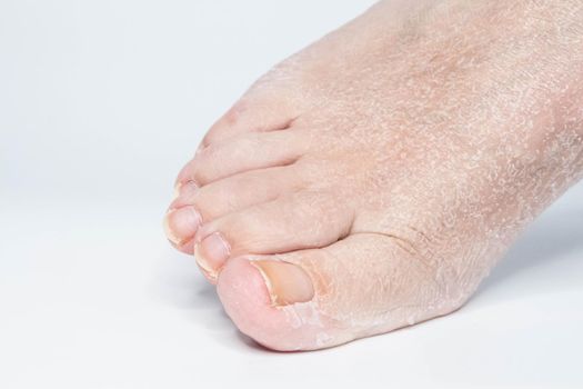 Close-up view female sore skin of feet, dry heels isolated on a white background