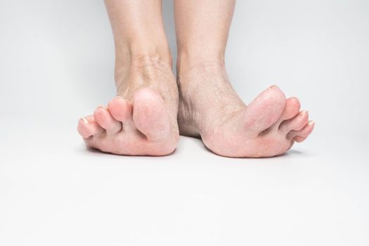 Close-up view female sore skin of feet, dry heels isolated on a white background