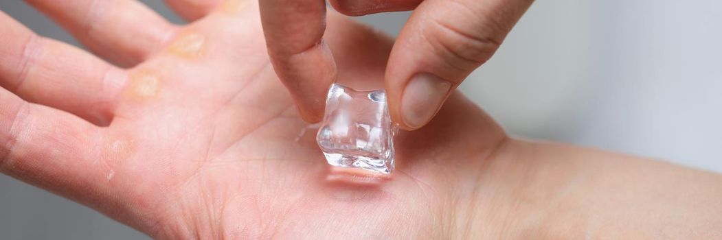 A piece of ice on the palm of a man, calluses on his hands, close-up. Rubbing the corn with ice. Dry skin, pain relief