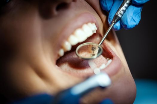 The beautiful young woman is at the dentist. She sits in the dentist's chair and the dentist repair her teeth. Close-up.