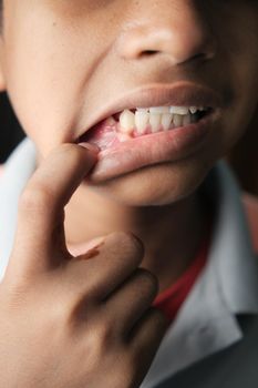 child with deformed teeth close up .