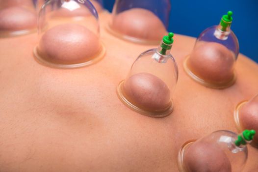 Close-up of a man's back with glass vacuum cans installed in a dark room of a spa salon.