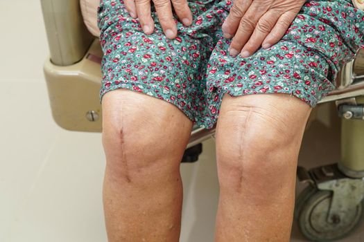 Asian elderly woman patient with scar knee replacement surgery in hospital.