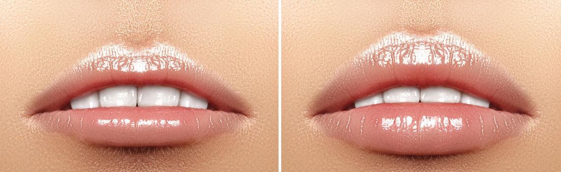 Before and after lips filler injections. Beauty plastic. Beautiful perfect lips with natural makeup. Sexy macro with female mouth.Plump lips augmentation. Salon procedure