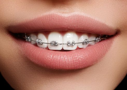 Beautiful macro shot of white teeth with braces. Dental care photo. Beauty woman smile with ortodontic accessories. Orthodontics treatment. Closeup of healthy female mouth