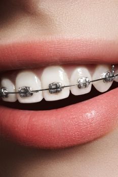 Beautiful macro shot of white teeth with braces. Dental care photo. Beauty woman smile with ortodontic accessories. Orthodontics treatment. Closeup of healthy female mouth