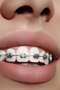 Beautiful macro shot of white teeth with braces. Dental care photo. Beauty woman smile with ortodontic accessories. Orthodontics treatment. Closeup of healthy female mouth