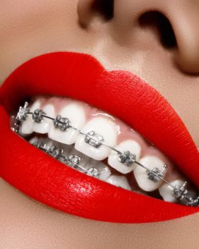 Beautiful macro shot of white teeth with braces. Dental care photo. Beauty woman smile with ortodontic accessories. Orthodontics treatment. Closeup of healthy female mouth