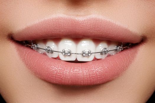 Beautiful macro shot of white teeth with braces. Dental care photo. Beauty woman smile with ortodontic accessories. Orthodontics treatment. Closeup of healthy female mouth