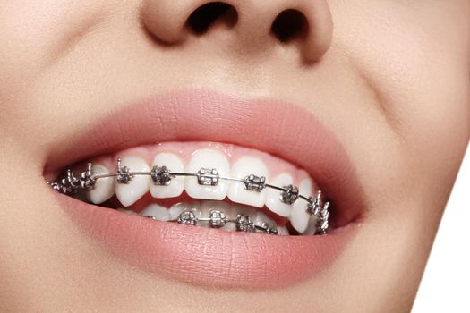 Beautiful macro shot of white teeth with braces. Dental care photo. Beauty woman smile with ortodontic accessories. Orthodontics treatment. Closeup of healthy female mouth