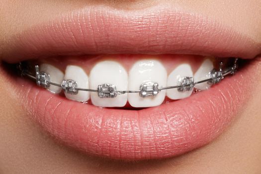 Beautiful macro shot of white teeth with braces. Dental care photo. Beauty woman smile with ortodontic accessories. Orthodontics treatment. Closeup of healthy female mouth