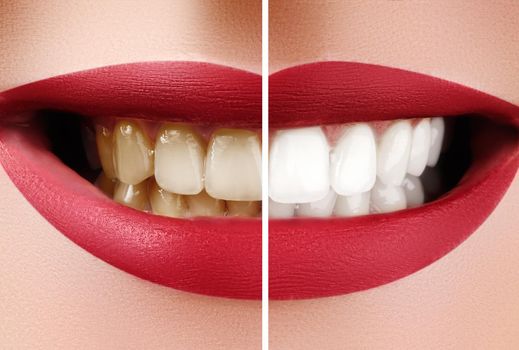 Closeup Macro of Female Teeth Before and After Whitening. Dental Health and Oral Care Concept. Happy Smile with Red Lips.