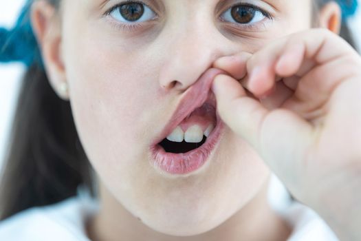 Adult permanent teeth coming in front of the child baby teeth: shark teeth. Little girl's open mouth. consultation of dentist. problem