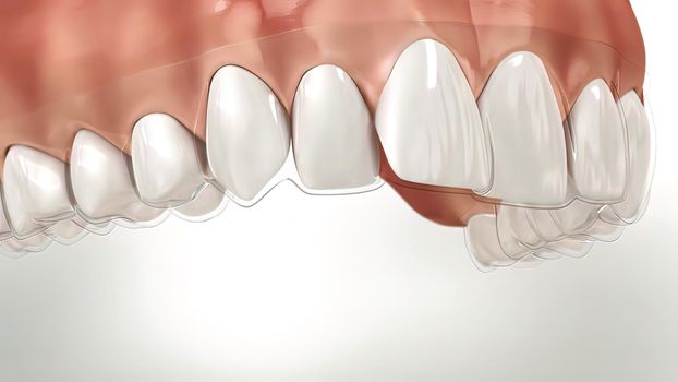 Invisalign braces or invisible retainer make bite correction. Medically accurate .3D illustration