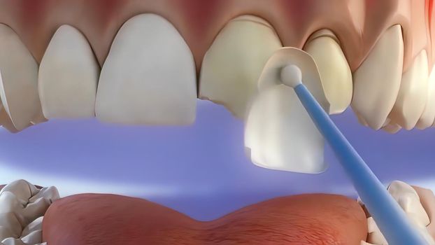 The process of chipping damaged teeth . 3D illustration