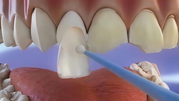 The process of chipping damaged teeth . 3D illustration