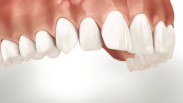 The process of chipping damaged teeth . 3D illustration