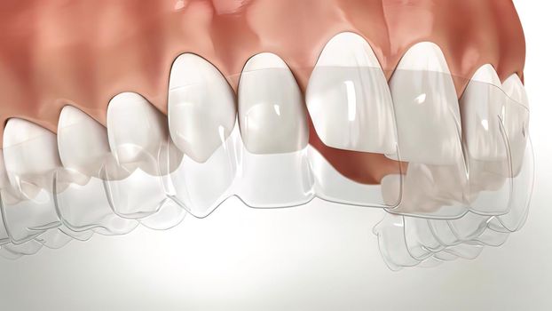 Invisalign braces or invisible retainer make bite correction. Medically accurate .3D illustration