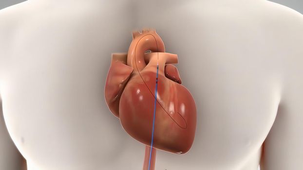 of balloon angioplasty with stent procedure used to widen artery blocked by cholesterol plaque, a common intervention in case of heart attack. Also available version without stent.3D illustration