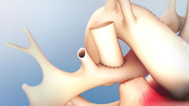 The Cardiovascular system. Hypoplastic left heart syndrome 3D illustration