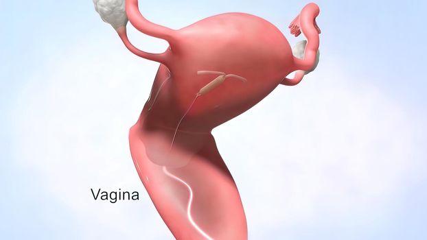 An IUD is a small device inserted into your uterus to prevent pregnancy. 3D illustration