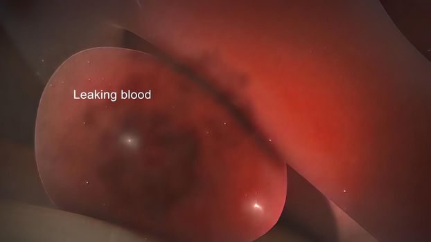 A brain aneurysm can leak or rupture, causing bleeding into the brain (hemorrhagic stroke). 3d illustration