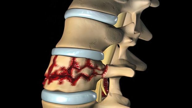 Cervical nerve roots exit the cervical spine through the intervertebral foramina between the vertebrae. 3D illustration