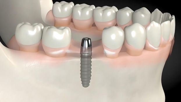 Dental implant surgery. A dental implant is a metal post that replaces the root portion of a missing tooth. 3D illustration