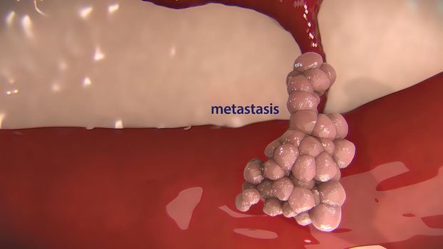 Metastasis for cancer that spreads to a different part of the body from where it started. 3D illustration