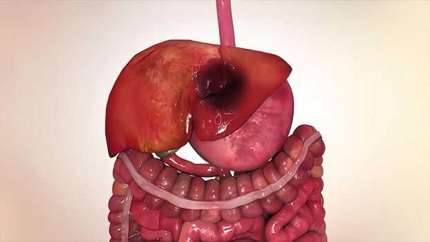 Cancer cell tumor, medical illustration. Neoplasm. Inflammation caused by an abnormal growth of tissue, whether benign or malignant. 3D illustration