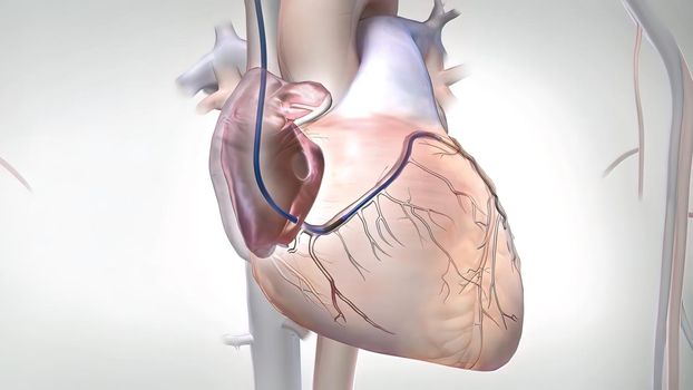 Coronary artery bypass grafting (CABG) is a type of surgery that improves blood flow to the heart. Its used for people who have severe coronary heart disease.3D illustration