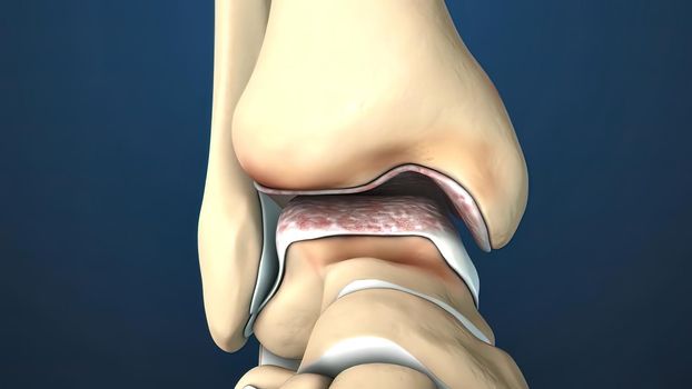 injury to the ankle and stretching 3D illustration