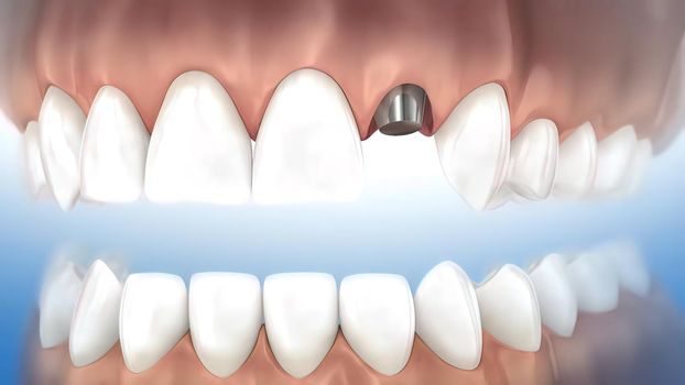 Dental implant surgery. A dental implant is a metal post that replaces the root portion of a missing tooth. 3D illustration