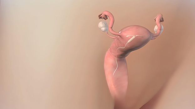 An IUD is a small device inserted into your uterus to prevent pregnancy. 3D illustration