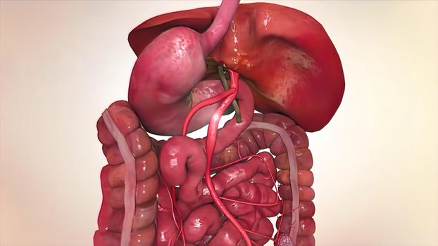 Metastatic cancer is commonly called stagecancer or advanced cancer. It occurs when cancer cells break off from the original tumor, spread 3D illustration