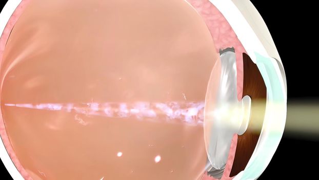 Common causes of sudden vision loss include eye trauma, obstruction of blood flow to the retina, and pulling of the retina away from its normal position at the back of the eye. 3D illustration