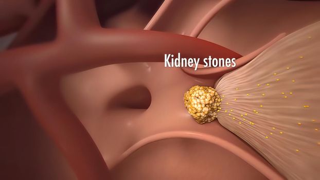 Kidney stones are small pebbles of salt and mineral in the urine. 3Dillustration