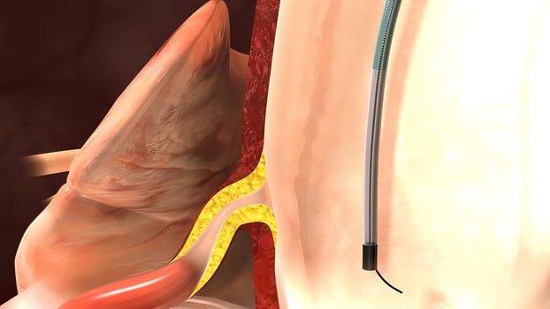 coronary angiography procedures 3D illustration