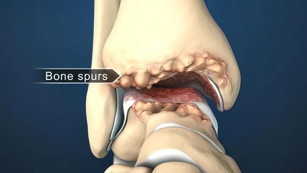 injury to the ankle and stretching 3D illustration