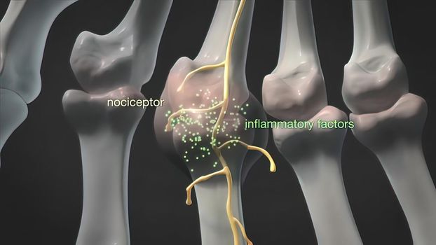 Swollen and inflamed knuckles, a condition that causes joint inflammation from a joint infection.3D illustration