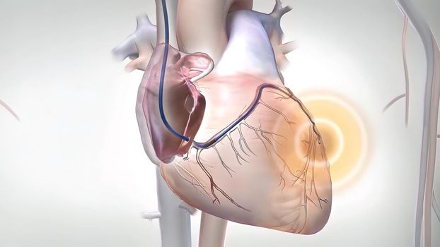 Coronary artery bypass grafting (CABG) is a type of surgery that improves blood flow to the heart. Its used for people who have severe coronary heart disease.3D illustration