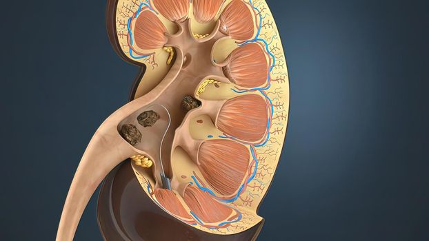 Lithotripsy treats kidney stones by sending focused ultrasonic energy or shock waves directly to the stone first located with fluoroscopy 3D illustration