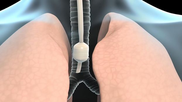 Intubation is the process of advancing a thin tube, called an endotracheal tube, from the mouth to the respiratory tract. 3D illustration