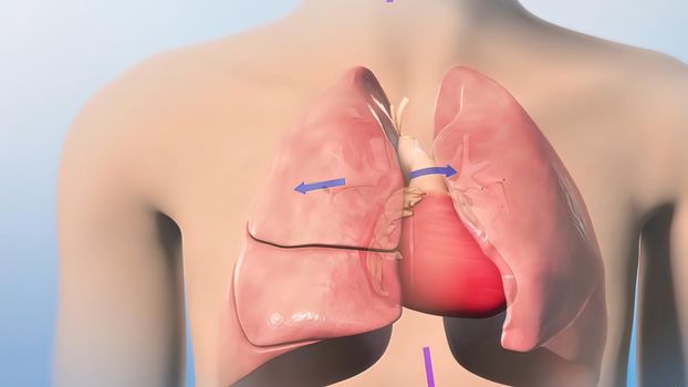 The Cardiovascular system. Hypoplastic left heart syndrome 3D illustration