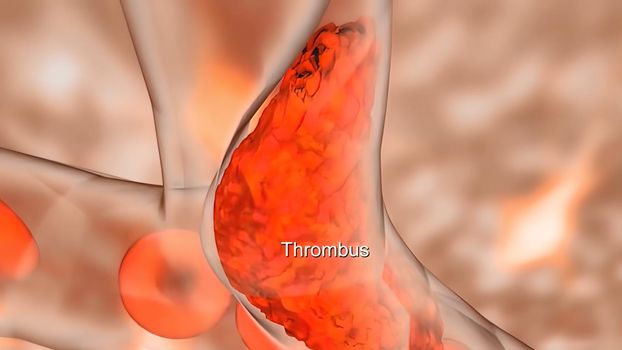 ischaemia is a restriction in blood supply to any tissues, muscle group, or organ of the body, causing a shortage of oxygen that is needed for cellular metabolism 3D illustration
