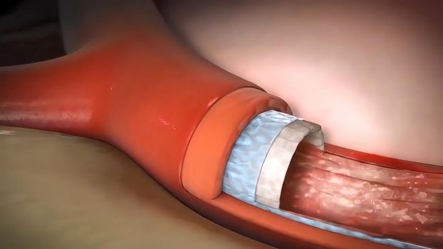 The three muscular layers are composed of the external oblique, internal oblique, and transversus abdominis muscles 3D illustration