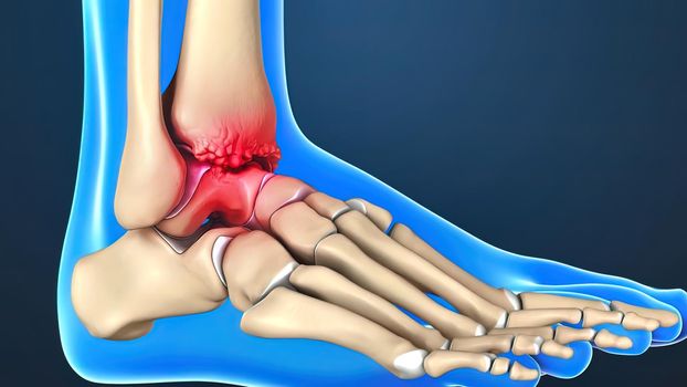 injury to the ankle and stretching 3D illustration