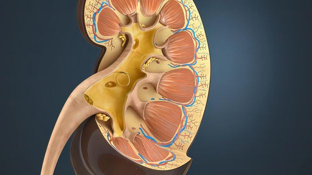 Lithotripsy treats kidney stones by sending focused ultrasonic energy or shock waves directly to the stone first located with fluoroscopy 3D illustration